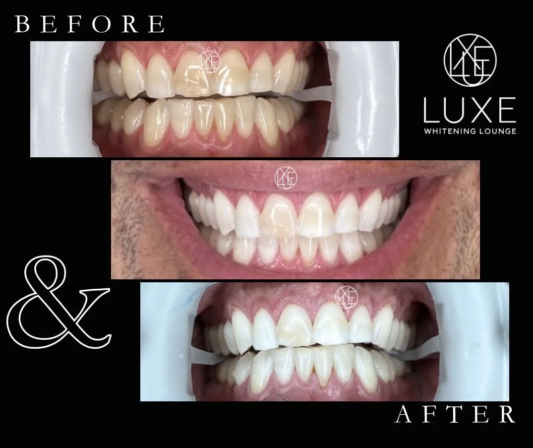 Professional teeth whitening results at LUXE Whitening Lounge