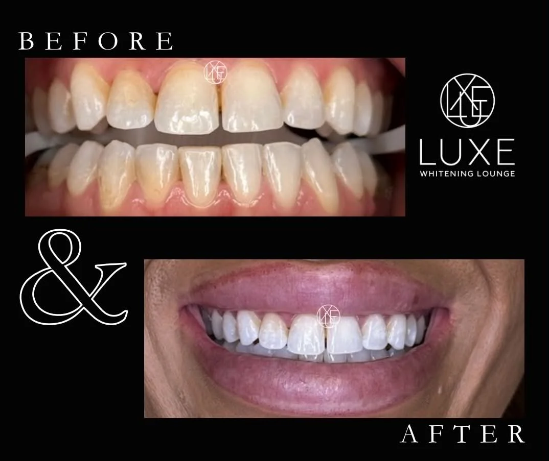 Professional teeth whitening results at LUXE Whitening Lounge