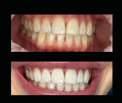 Comparison of teeth before and after whitening, showing improved brightness and stain removal.