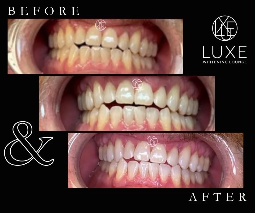 Set of three photographs showing teeth before and after whitening treatments, with a black background and white text indicating 'BEFORE' and 'AFTER'. The top image shows discolored teeth, the middle image shows some whitening progress, and the bottom