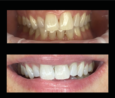 Close-up of a person's teeth before and after dental whitening, showing improved brightness and appearance.