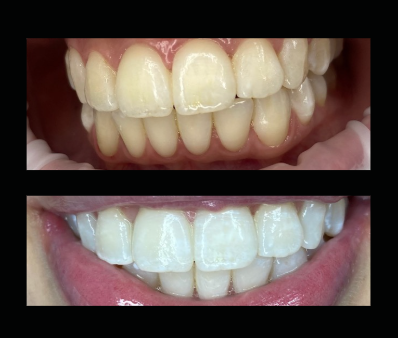 Comparison of teeth before and after whitening, showing improved brightness and stain removal.