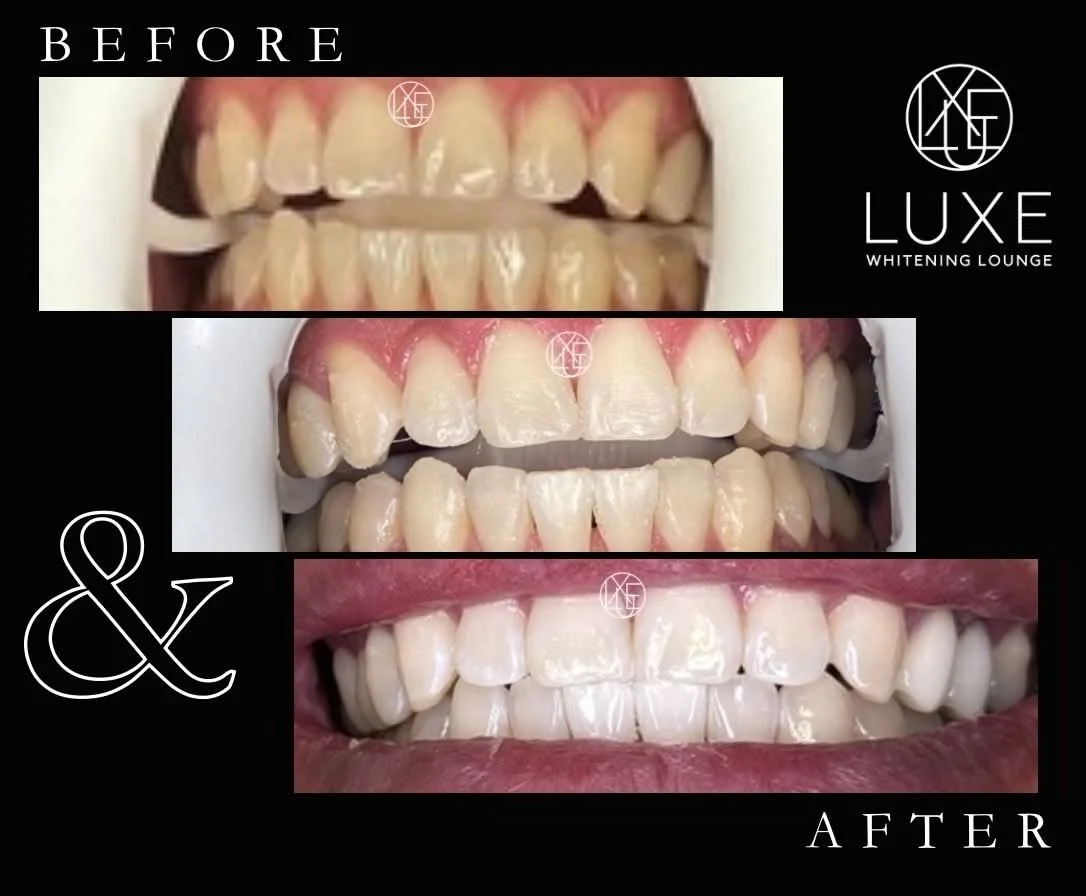 A collage showing a 'before and after' comparison of teeth whitening. The top image displays teeth before whitening, appearing yellowed. The middle image shows teeth after whitening, looking significantly whiter. The bottom image presents a close-up 