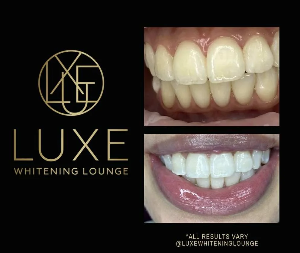 Before and after photos of teeth whitening, with the logo of Luxe Whitening Lounge and text indicating results may vary.