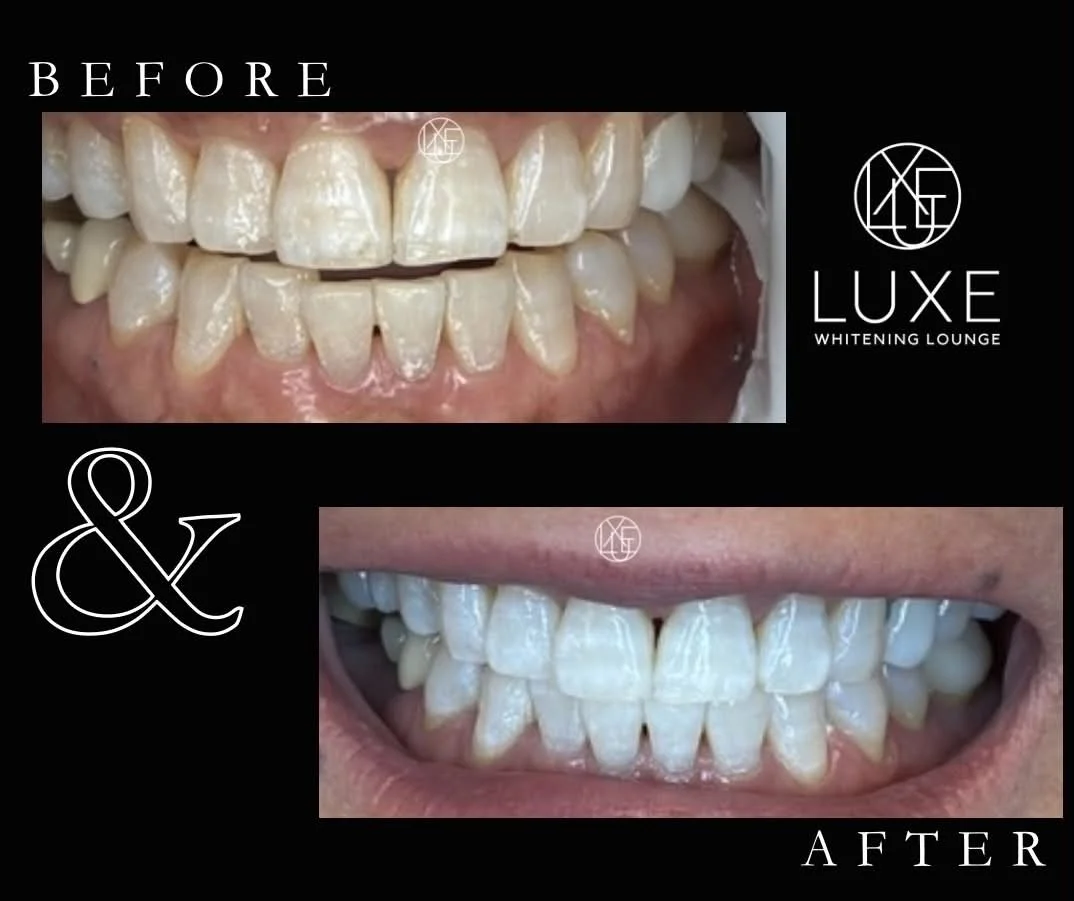 Comparison of teeth before and after teeth whitening, showing improved appearance after treatment at Luxe Whitening Lounge.