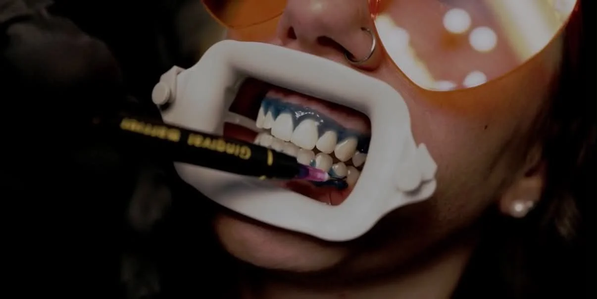 Grey teeth whitening retractor in clients mouth while blue gingival protective barrier is placed by teeth whitening specialist. Client is wearing orange LED protective glasses.