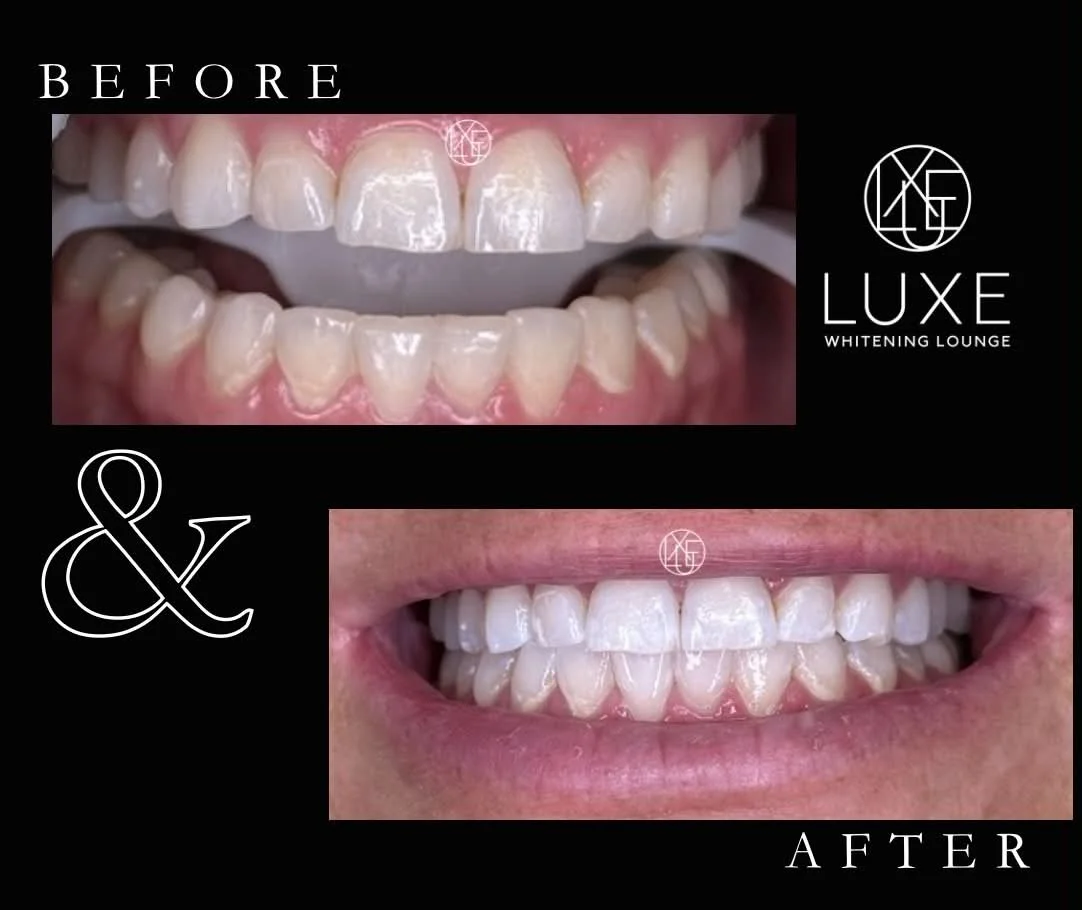 Comparison of teeth before and after whitening treatment showing improved brightness and appearance.
