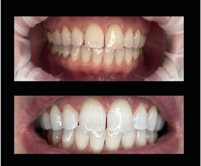Comparison of teeth before and after whitening, showing improved brightness and stain removal.