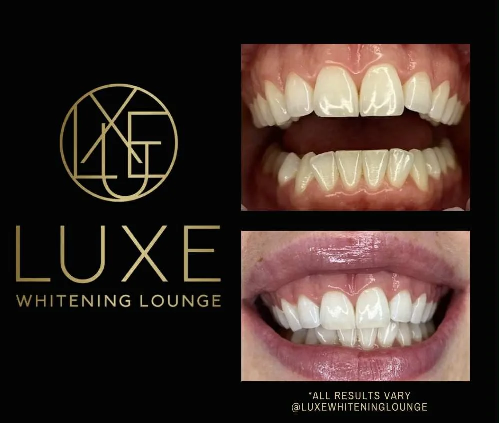 Before and after images of teeth whitening at Luxe Whitening Lounge, showing improved whiteness. Logo and text branding for Luxe Whitening Lounge with a disclaimer that results may vary.