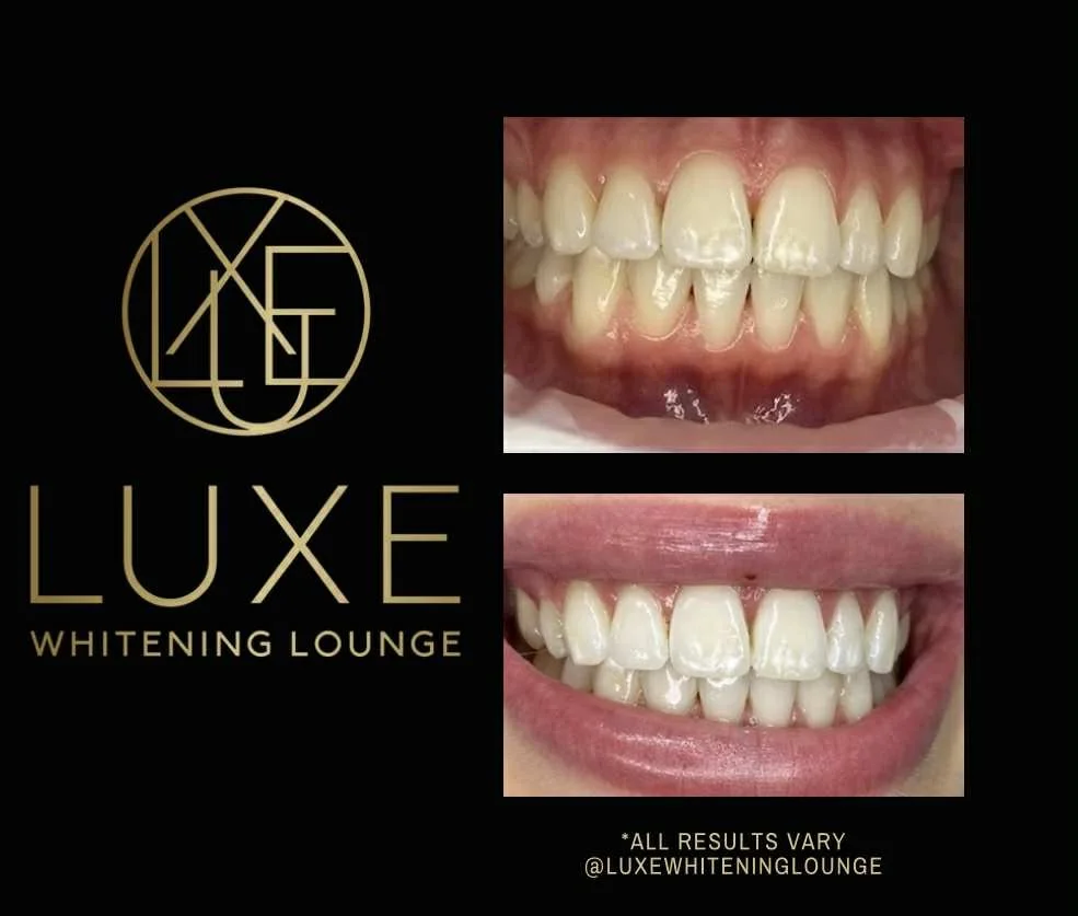 Comparison of teeth before and after whitening treatment at Luxe Whitening Lounge, showing improvement in teeth whiteness.
