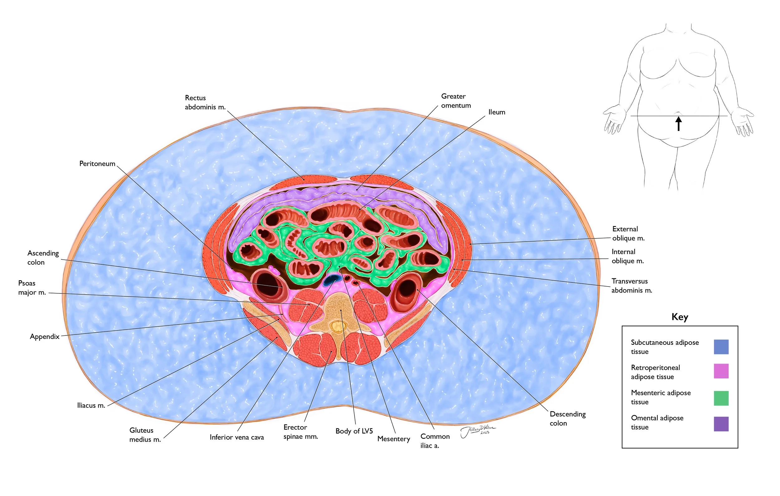 Visceral Adiposity Color coded labeled.jpg