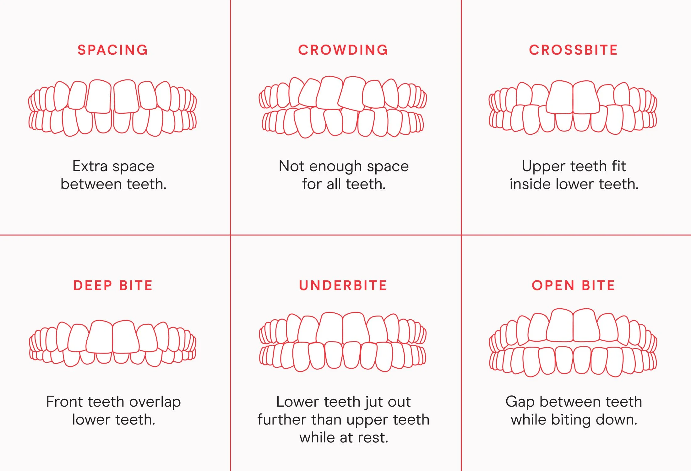 Chart showing types of malocclusion
