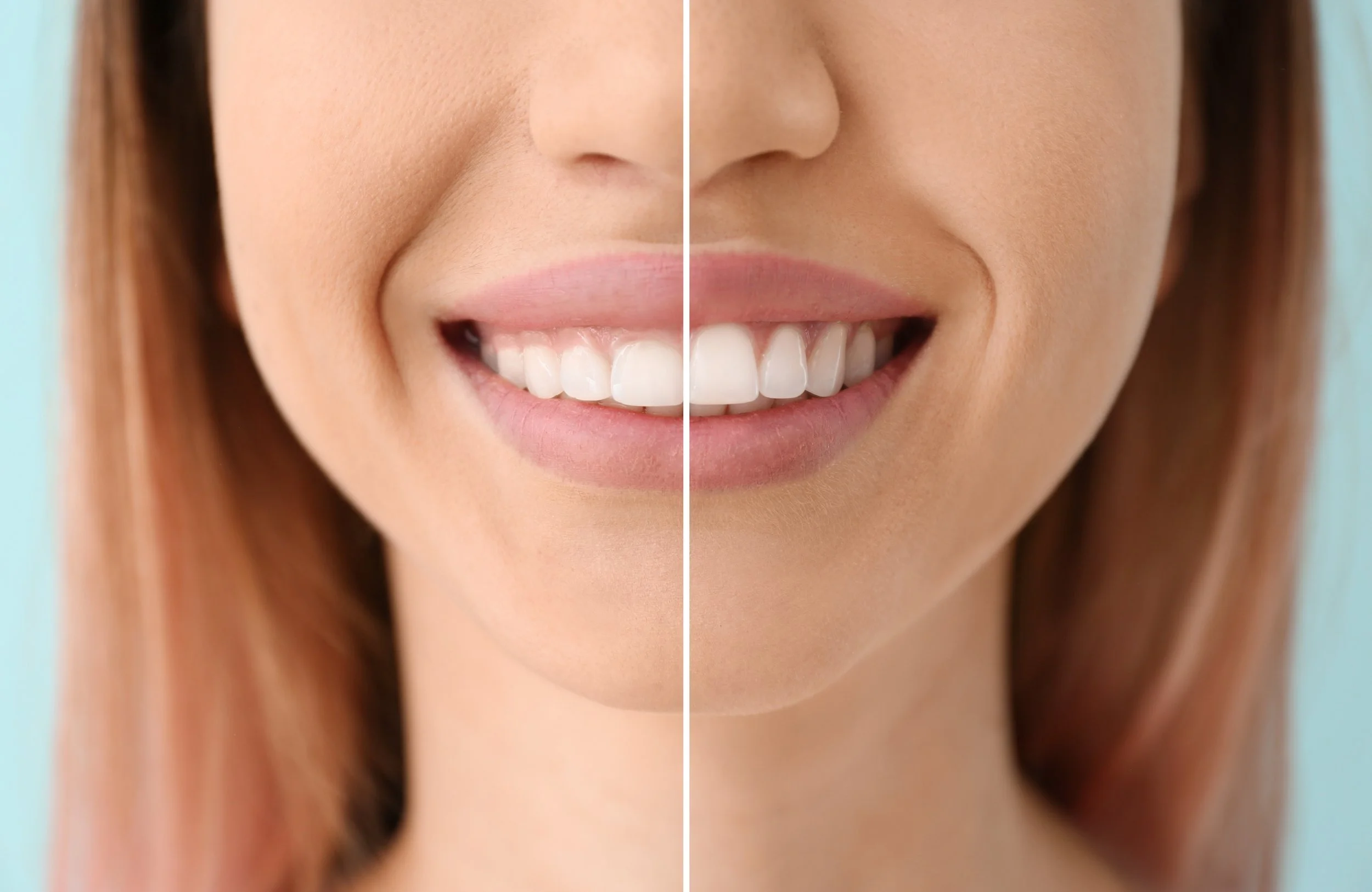 Close-up of a smiling woman with straight white teeth, showing a difference between her natural and whitened teeth on either side of her mouth.