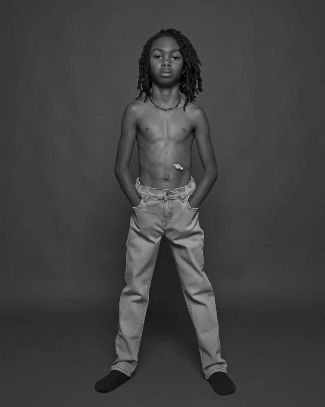 It was only after Chace Selby was born that his parents learned he has a rare heart condition called tetralogy of Fallot (TOF). He left hospital with a G-tube – which he still has today. 
Chace still finds tube-feeding helpful for putting on