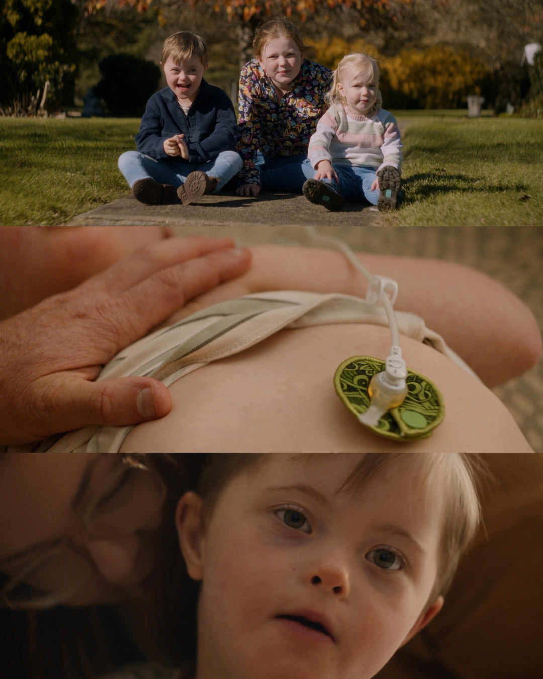 Three-panel image: three children sitting on grass, a close-up of a feeding tube button on a child’s tummy, and a child’s face.