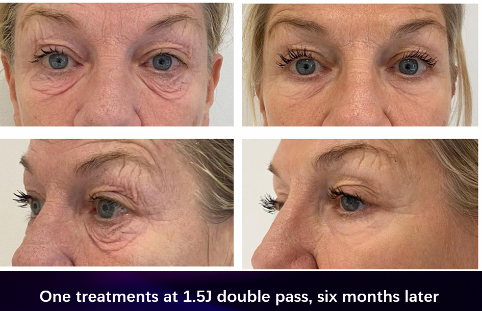 1x High Energy Mature Eye (6 months post treatment).png