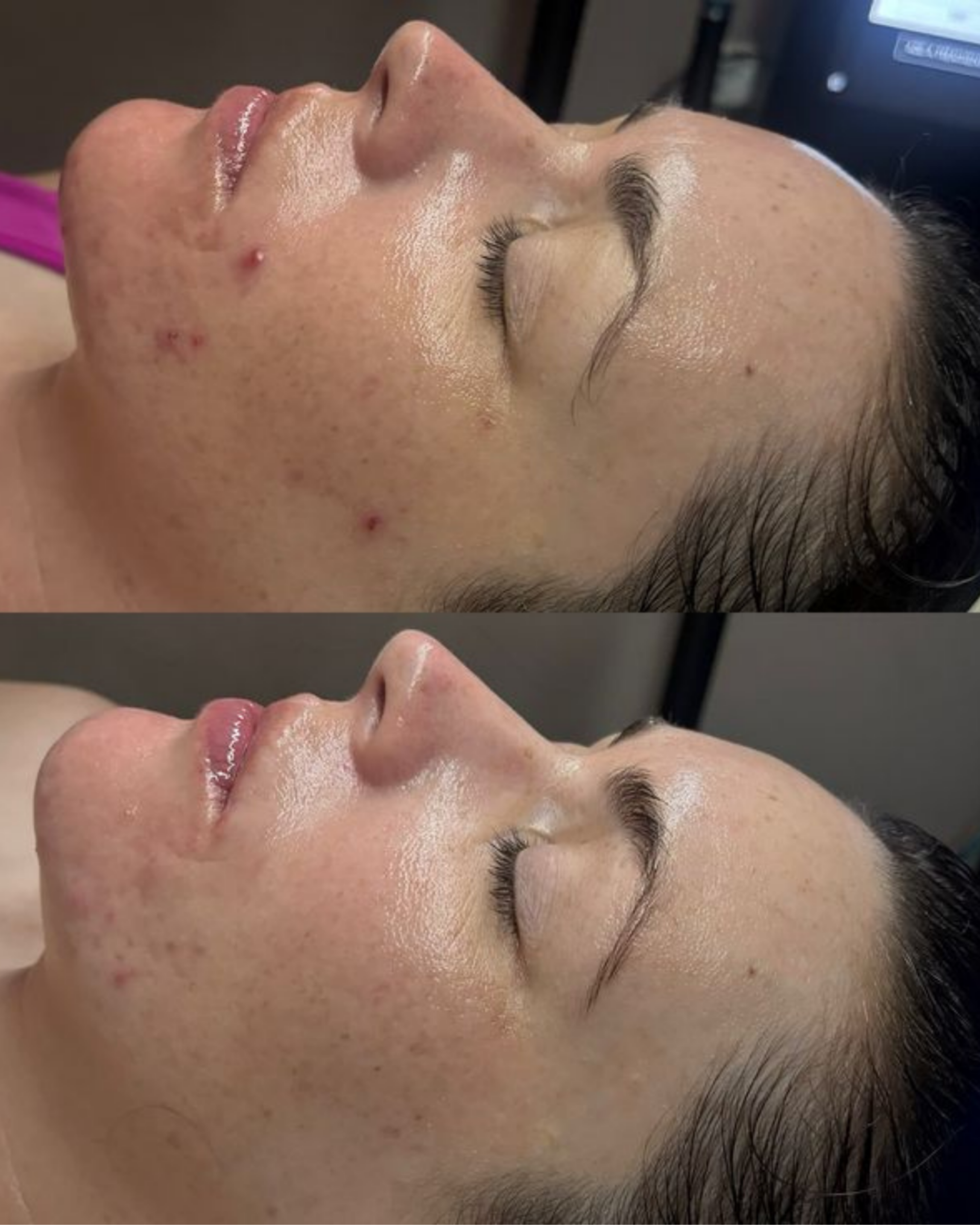 Acne: Understanding the Causes and Treatment Options