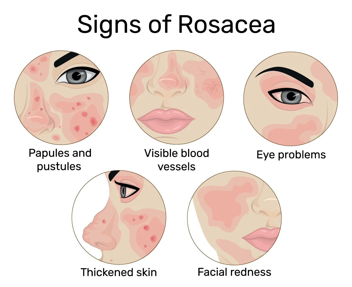 Rosacea: Understanding the Condition and Treatment Options
