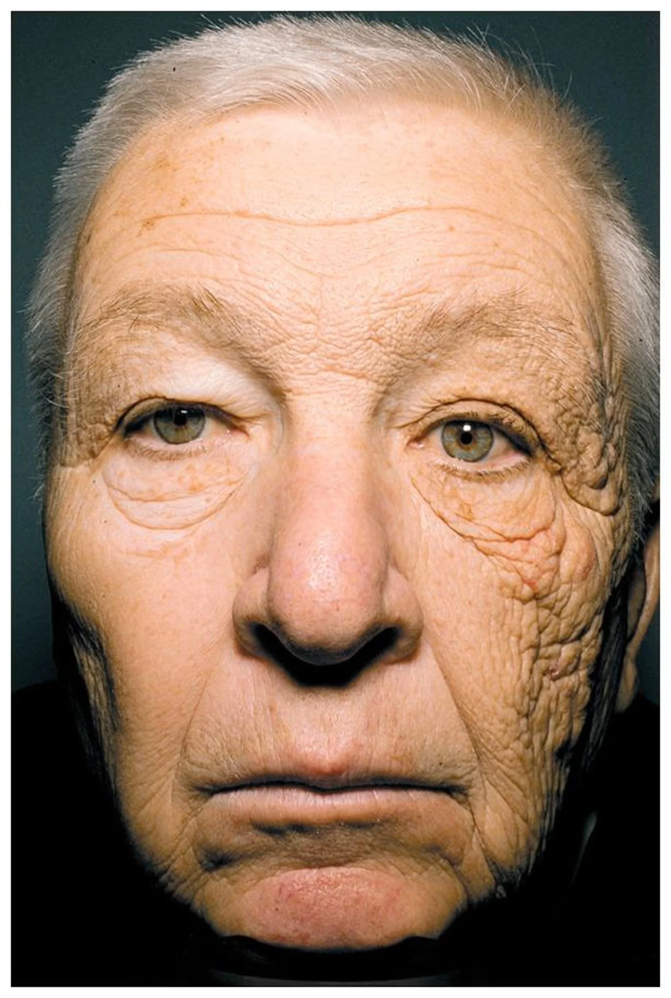 Signs of Sun-Damaged Skin
