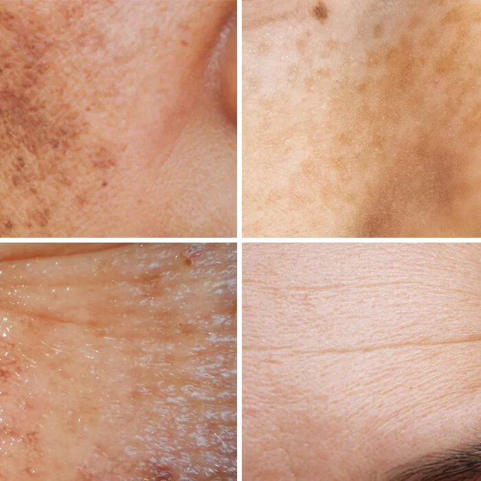 Signs of Sun-Damaged Skin