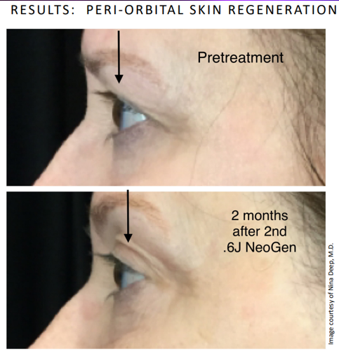 2x Low energy Hooded Eyes (2 months post treatment).png