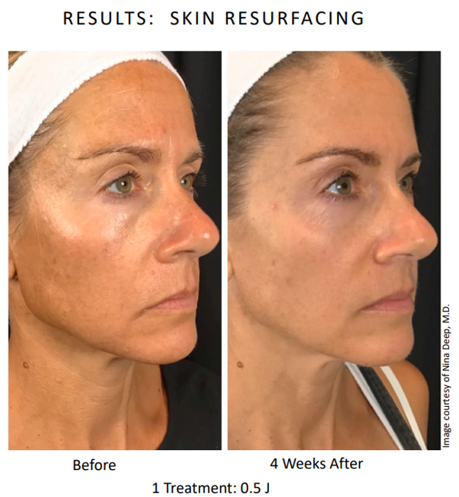 1x Low Energy Rejuvenation (4 weeks post treatment).png