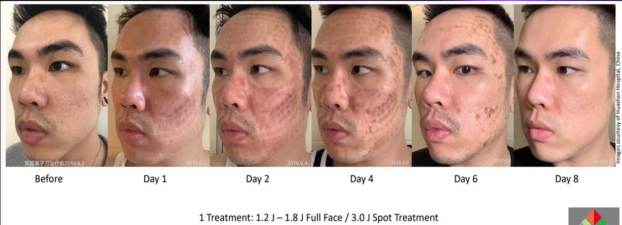 1x High Energy Acne Scarring (8 days post treatment).png