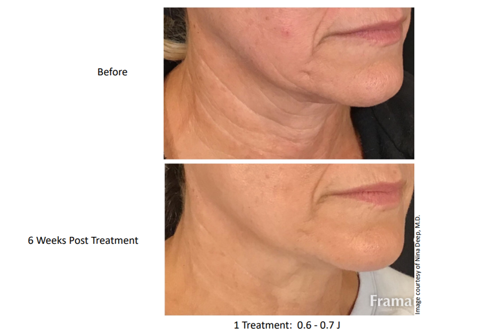 1x Low Energy Jowl (6 weeks post treatment).png