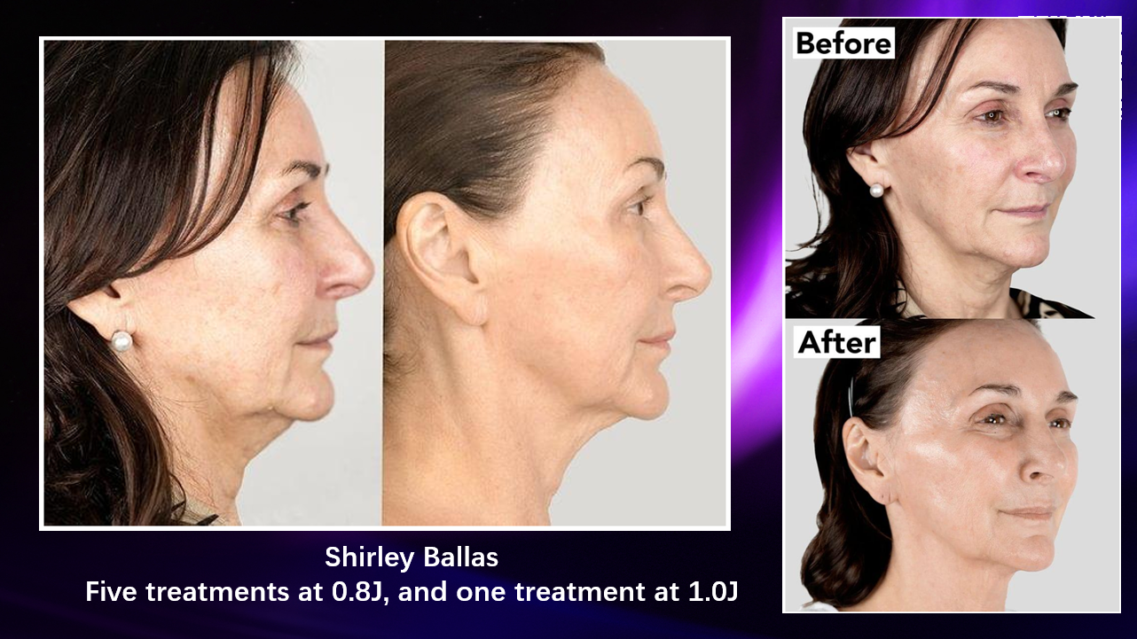 Mixed Energy Lifting and Rejuvenation - 5 x Low & 1 x High Energy.png