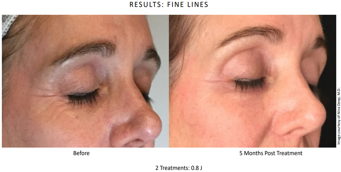2x Low Energy Eye (5 months post treatment).png