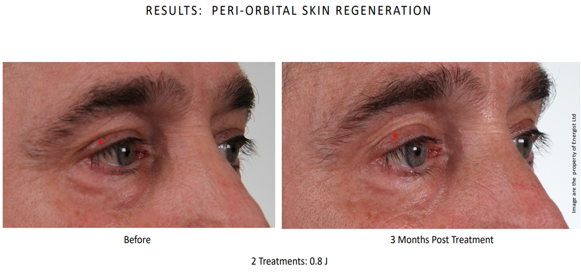 2x Low energy Eye Male (3 months post treatment).png