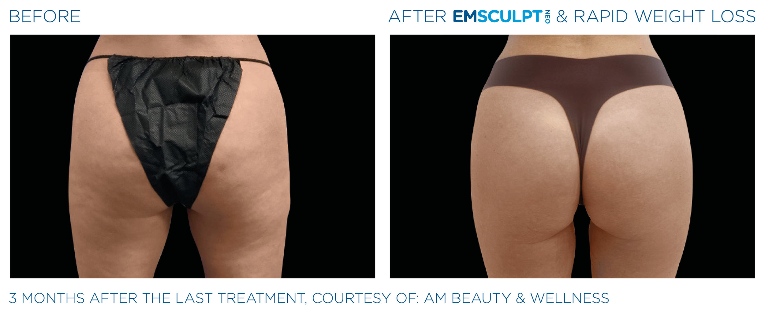 Emsculpt_Neo-Weight-Loss_PIC_Ba-card-female-buttocks-005_ENUS100.png