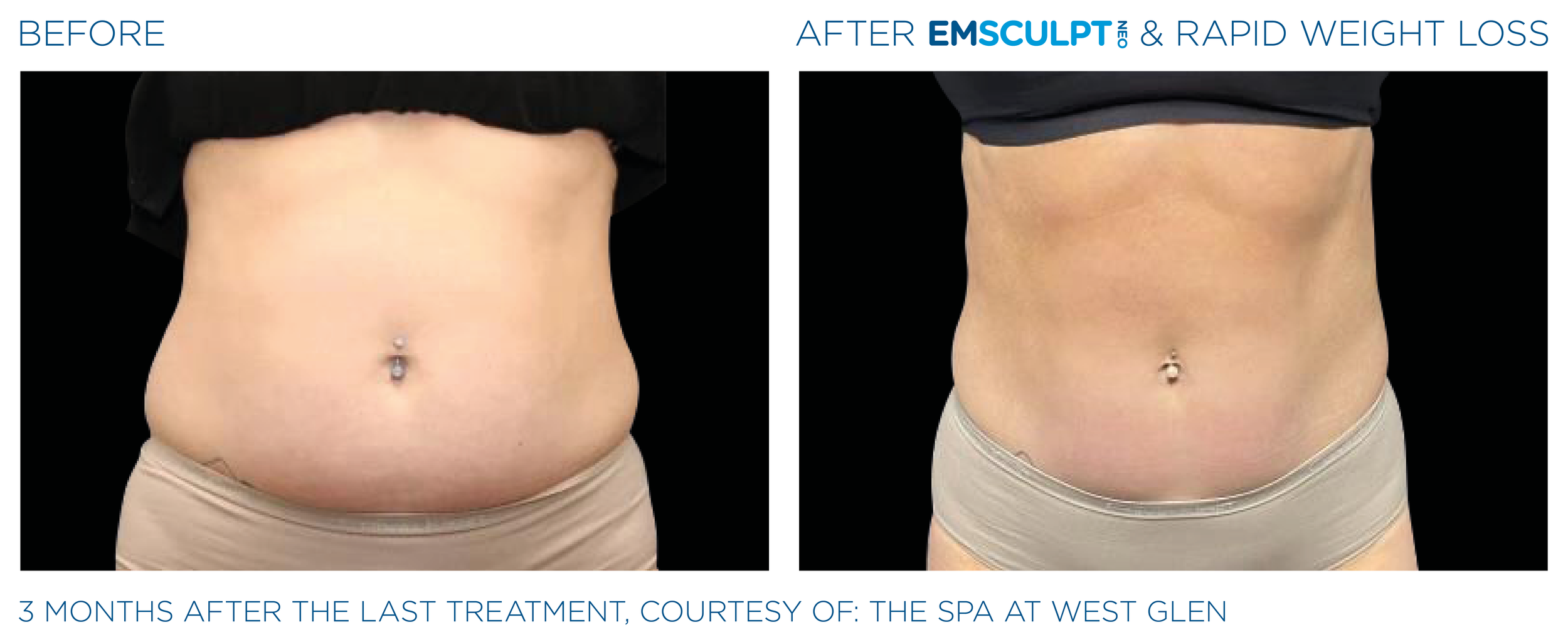 Emsculpt_Neo-Weight-Loss_PIC_Ba-card-female-abdomen-004_ENUS100.png