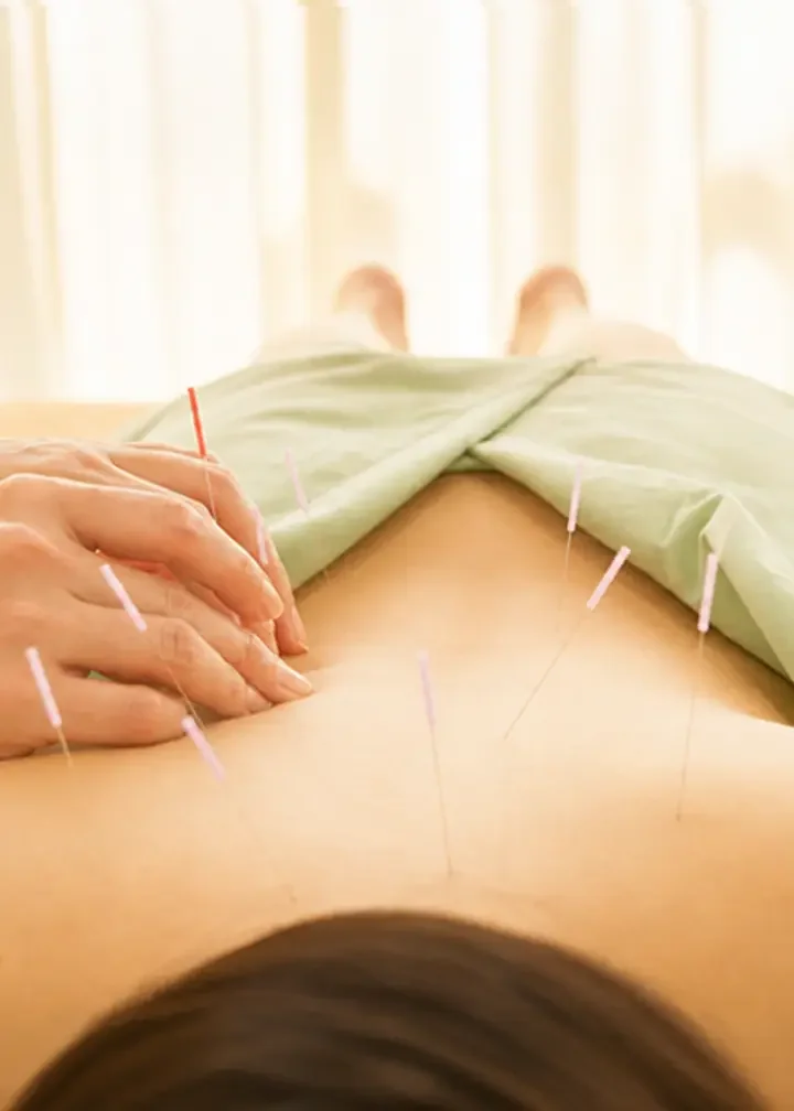 A person receiving acupuncture treatment on their back, with multiple thin needles inserted along their back.