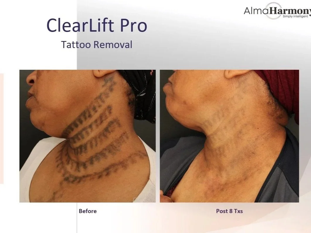 Treatment+Before+and+After+-+Harmony+Clearlift+on+tattoo+removal+2.jpg