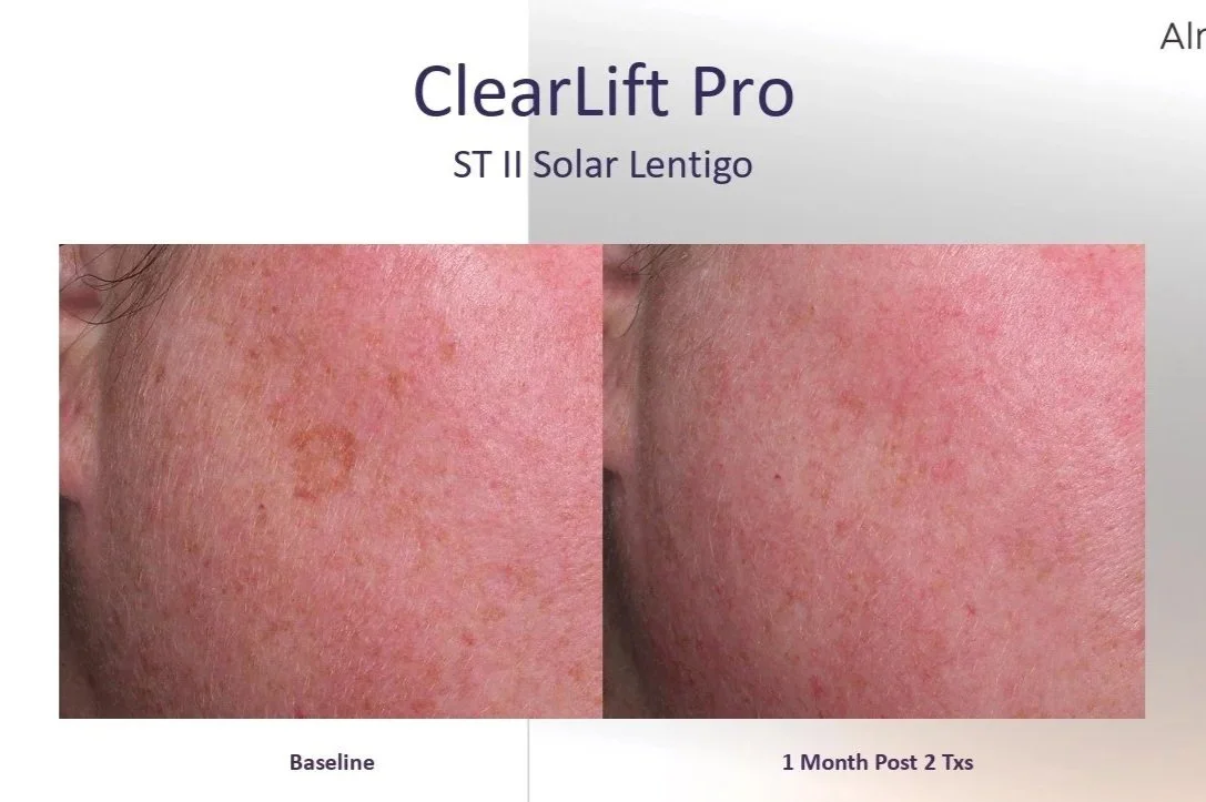 Treatment+Before+and+After+-+Harmony+Clearlift+on+solar+lentigo+1.jpg