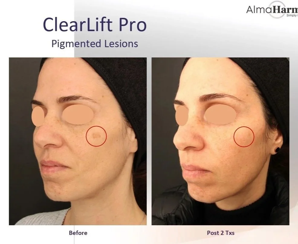 Treatment+Before+and+After+-+Harmony+Clearlift+on+melasma+1.jpg
