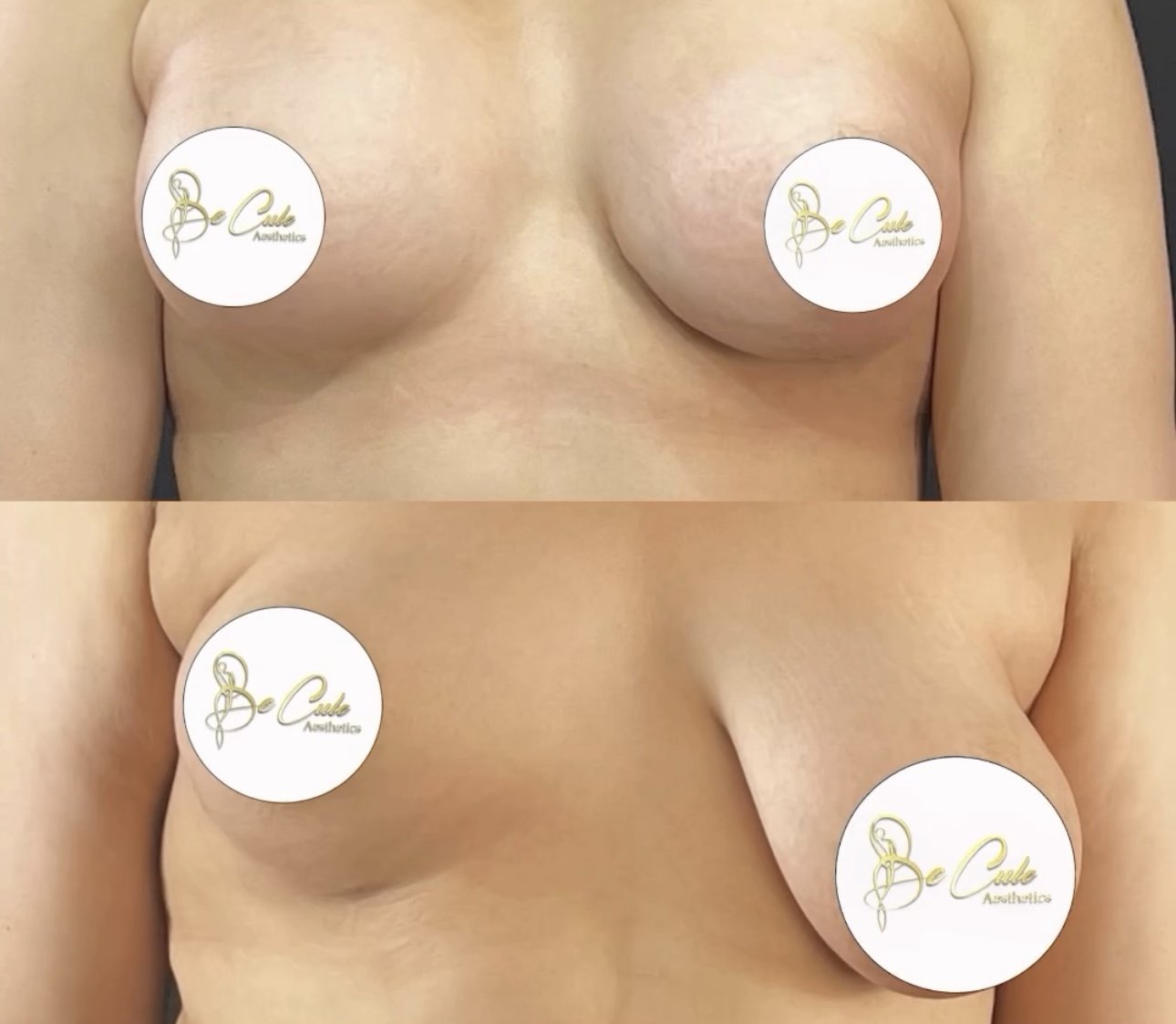 Reduction mammaire prothese