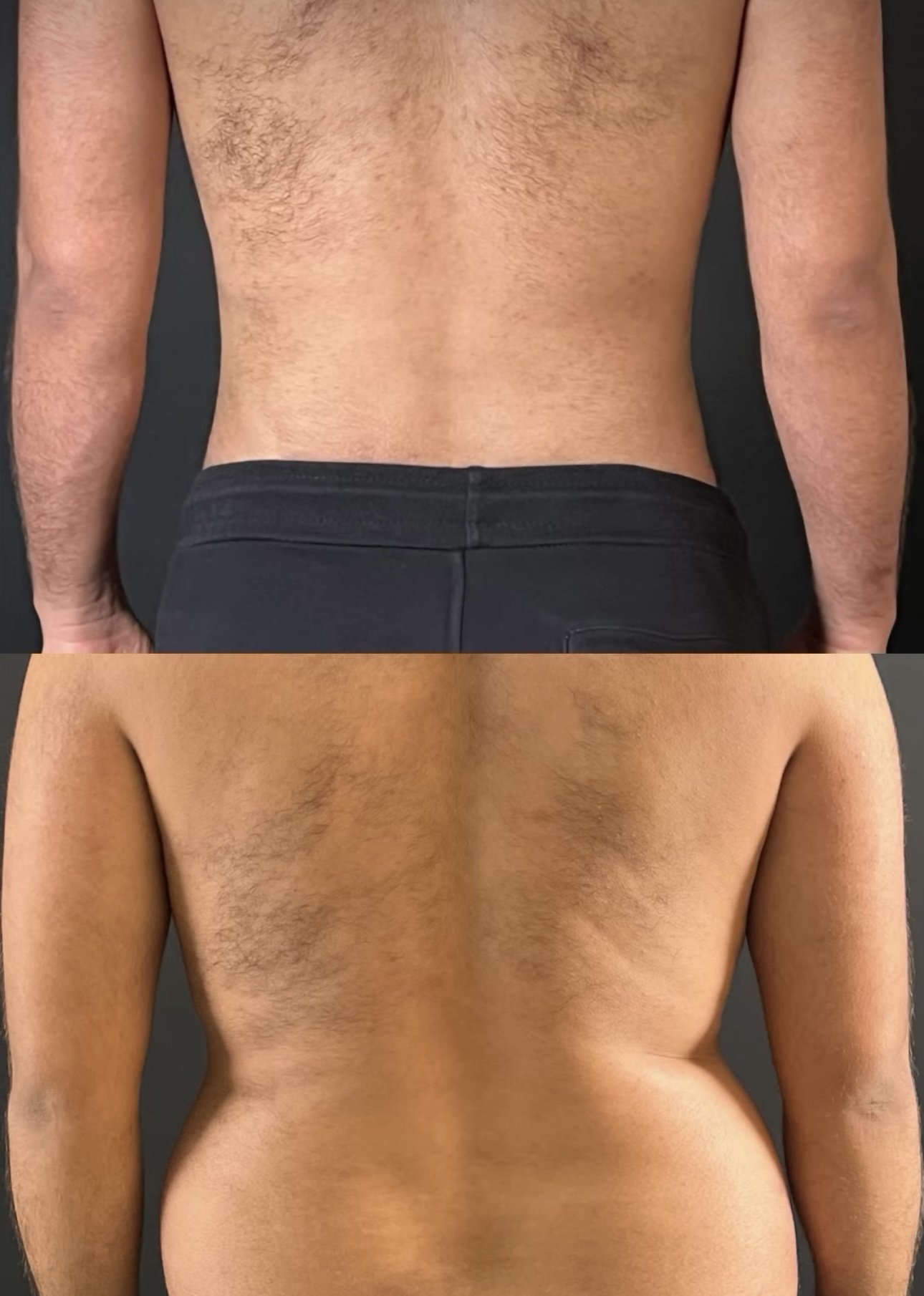 Liposuction homme Casablanca