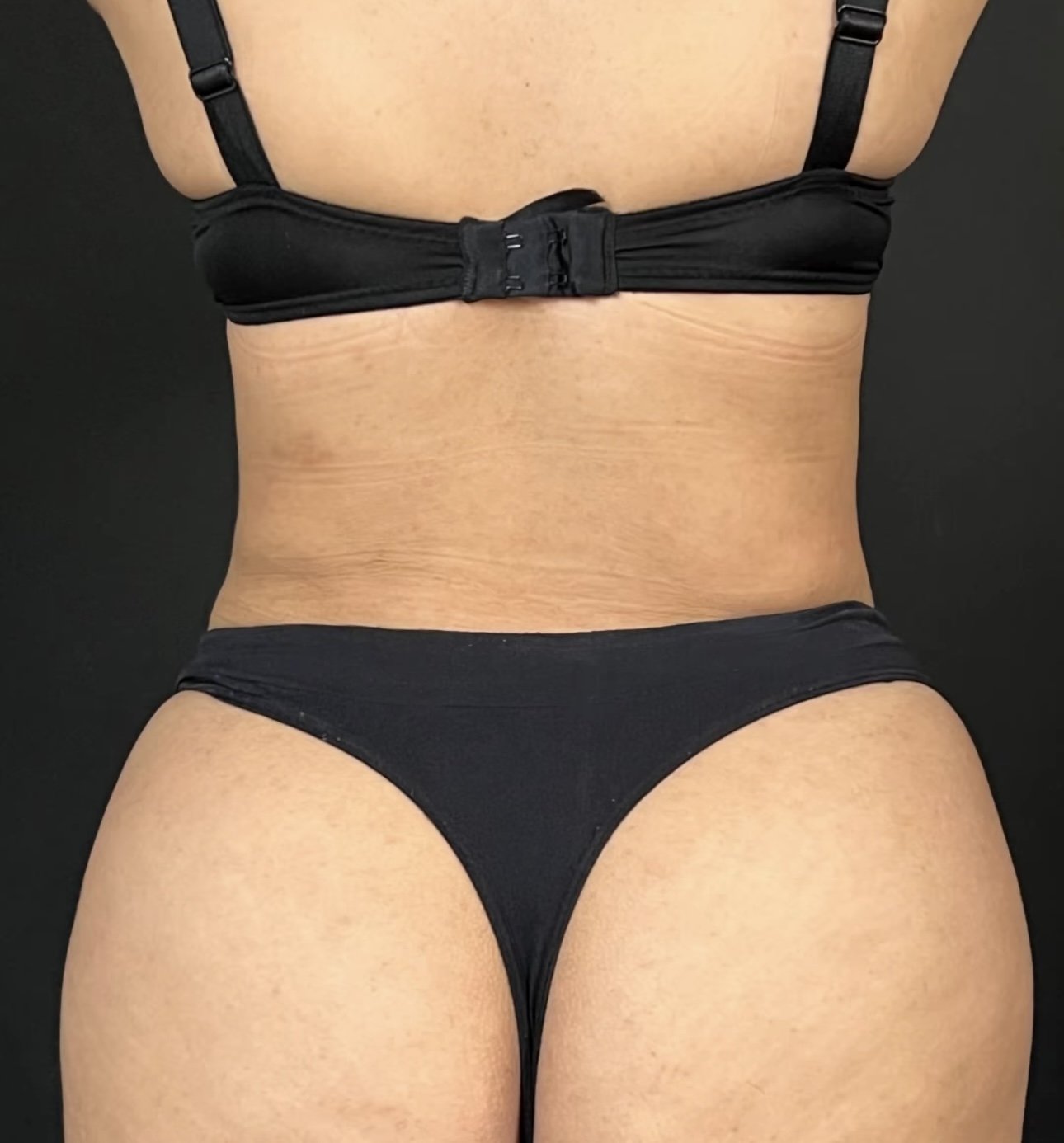 BBL Liposuction Casablanca