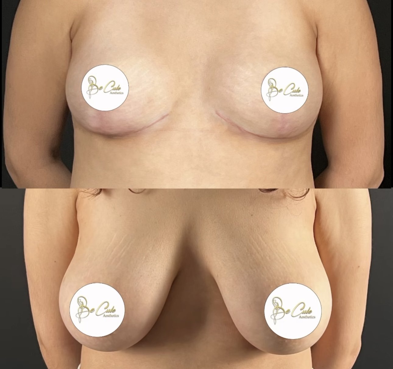 Reduction mammaire casablanca mastopexie