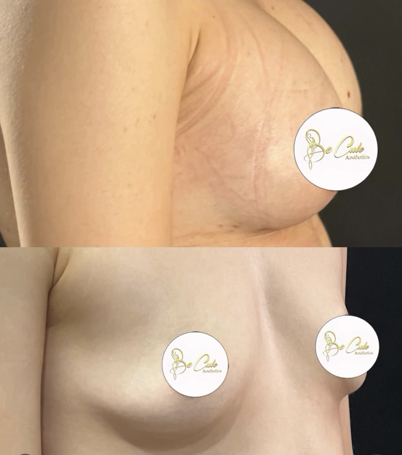 Augmentation mammaire prothese casablanca