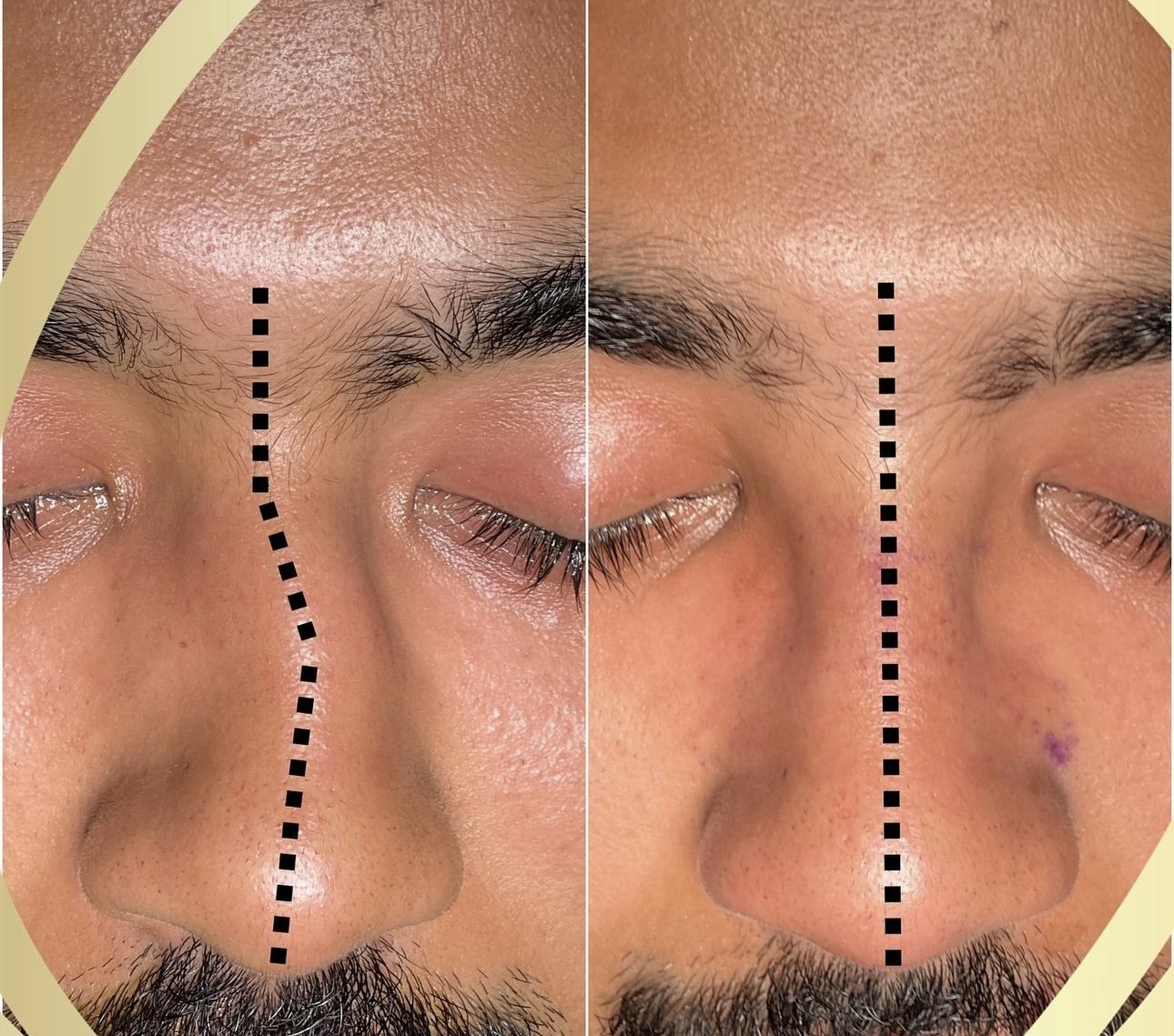 Rhinoplastie