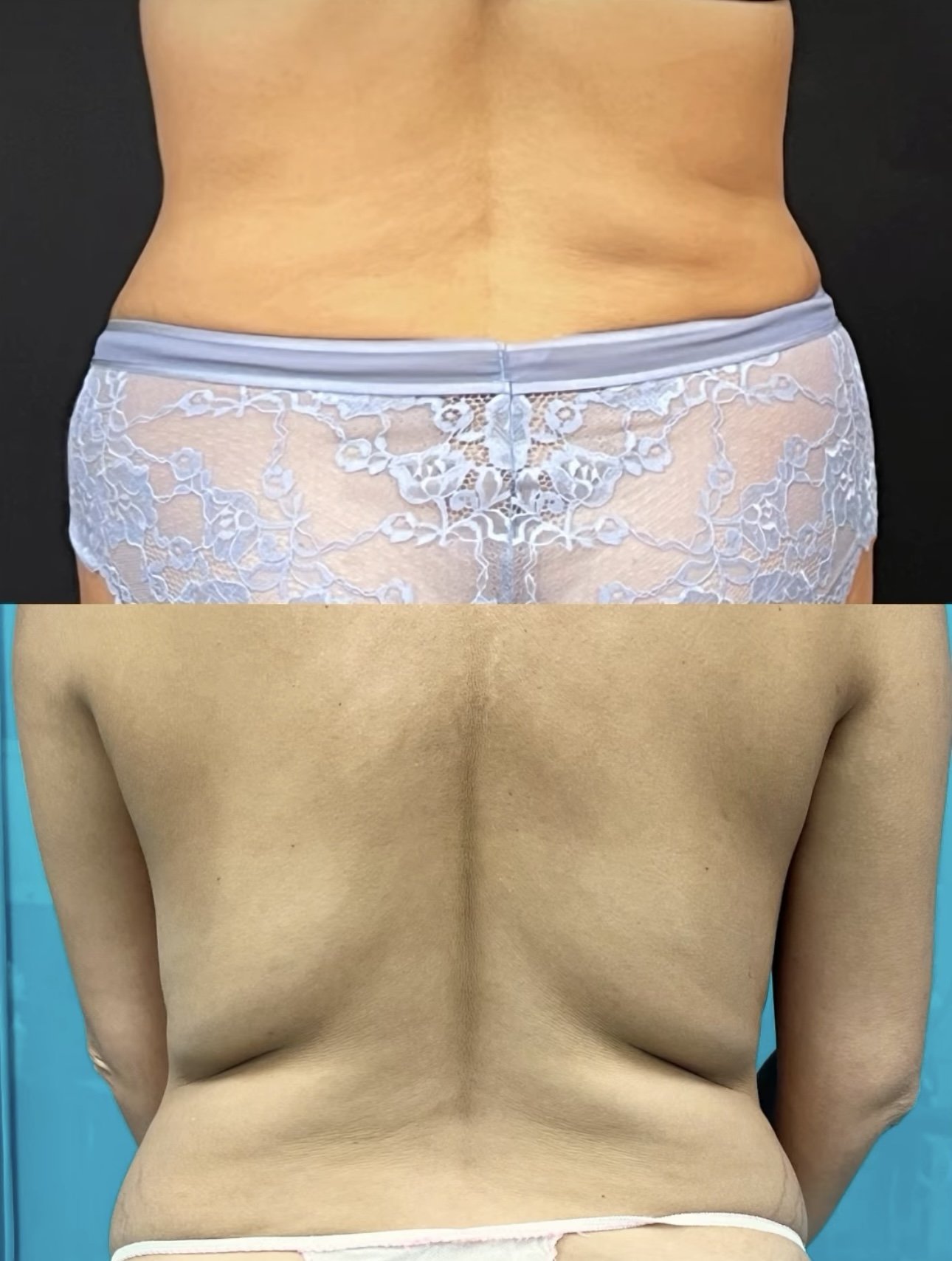 BBL Liposuction Casablanca