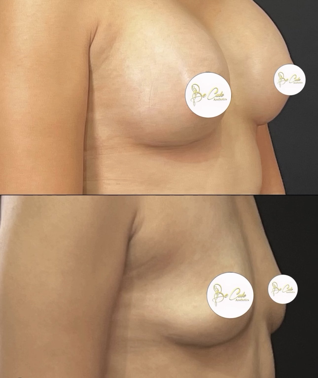 Augmentation mammaire breast lift