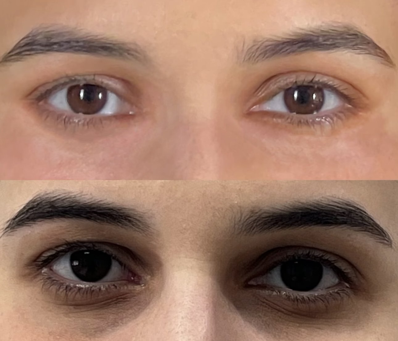 blepharoplastie casablanca