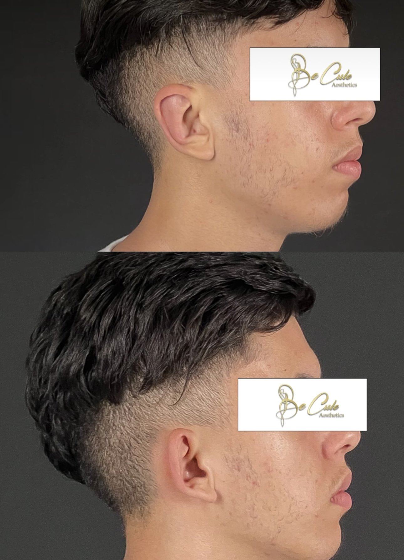 otoplastie homme casablanca