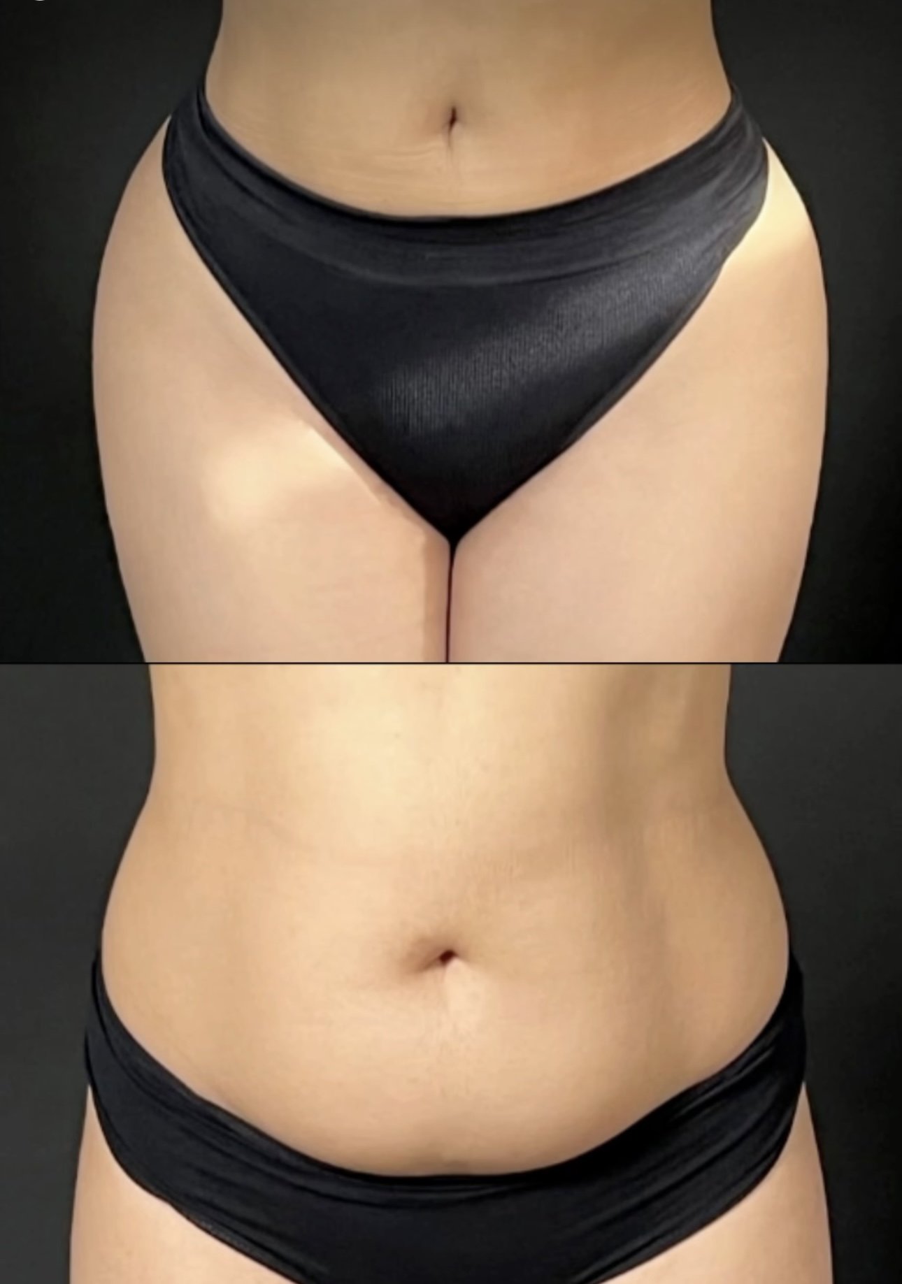 Liposuction Casablanca