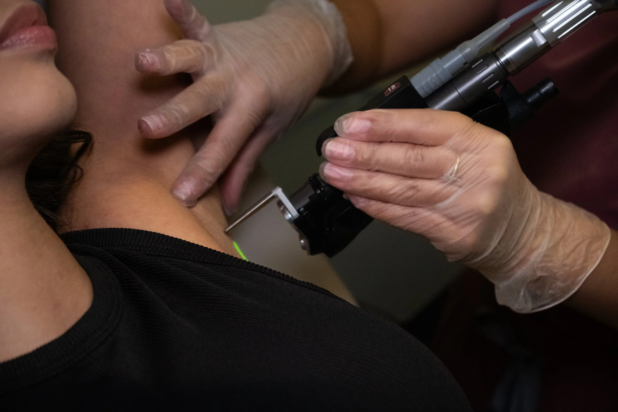 Does Laser Hair Removal Work on Dark Skin? The Truth From an Orlando Laser Specialis