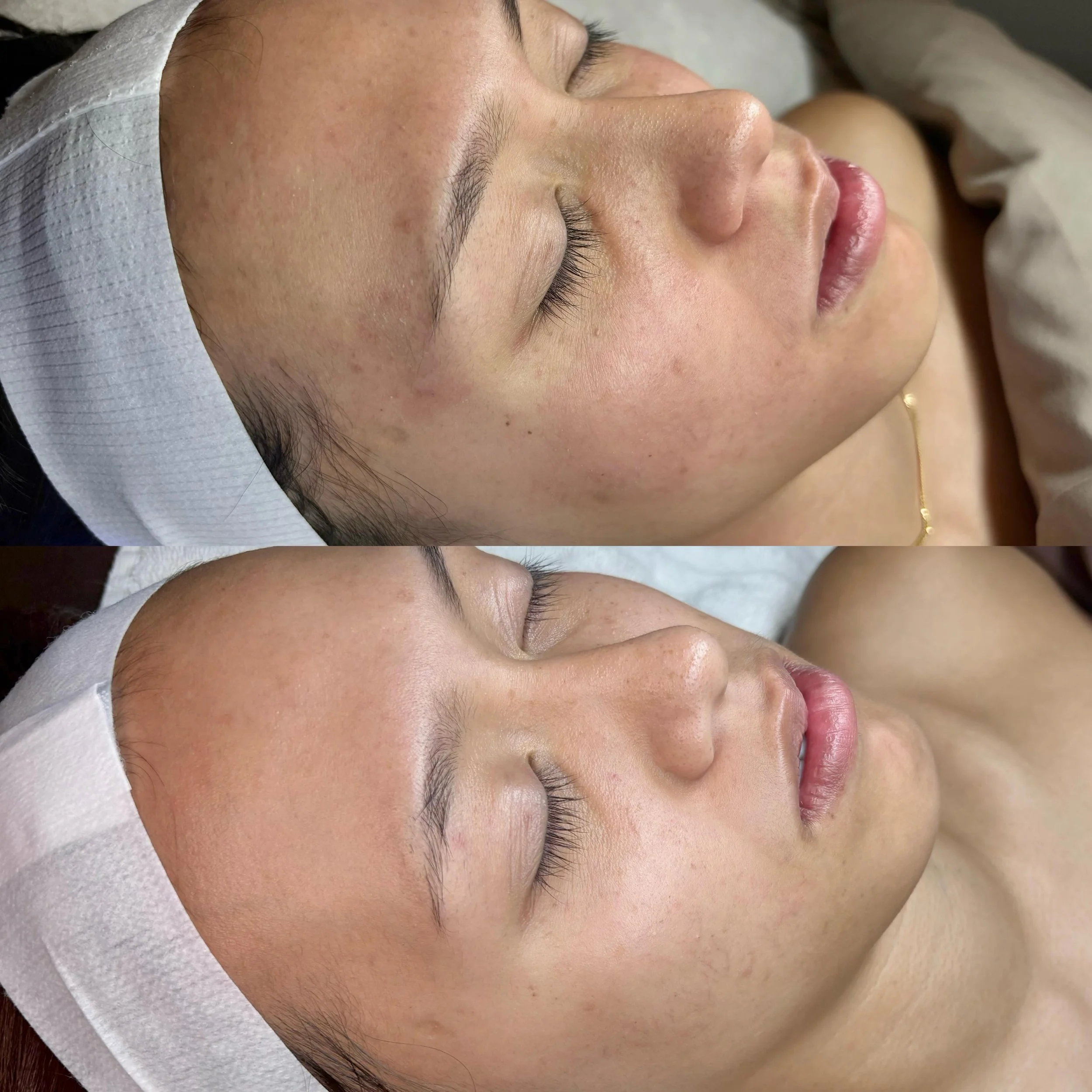 This is what happens when a client trusts the process. 

When she first came to us, her skin was reactive, blemish-prone, and even products would sting when she applied them. 

That told us her barrier needed support before we could focus on anything